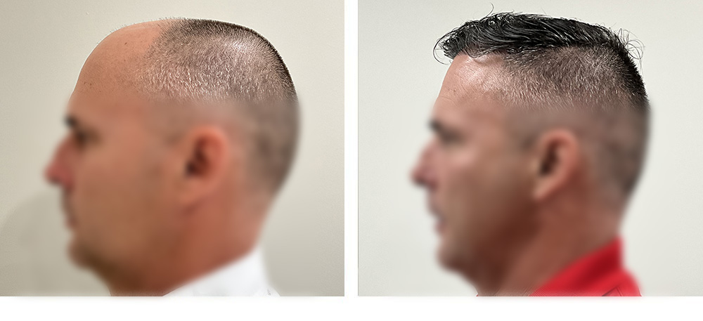 Hair Transplant Before and After