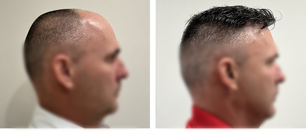 Hair Transplant Before and After
