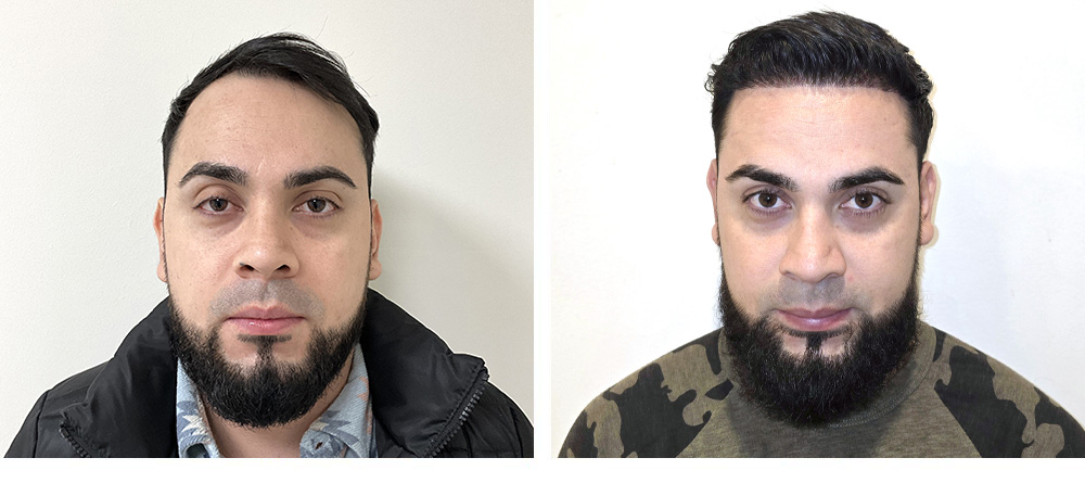 Hair Transplant Before and After