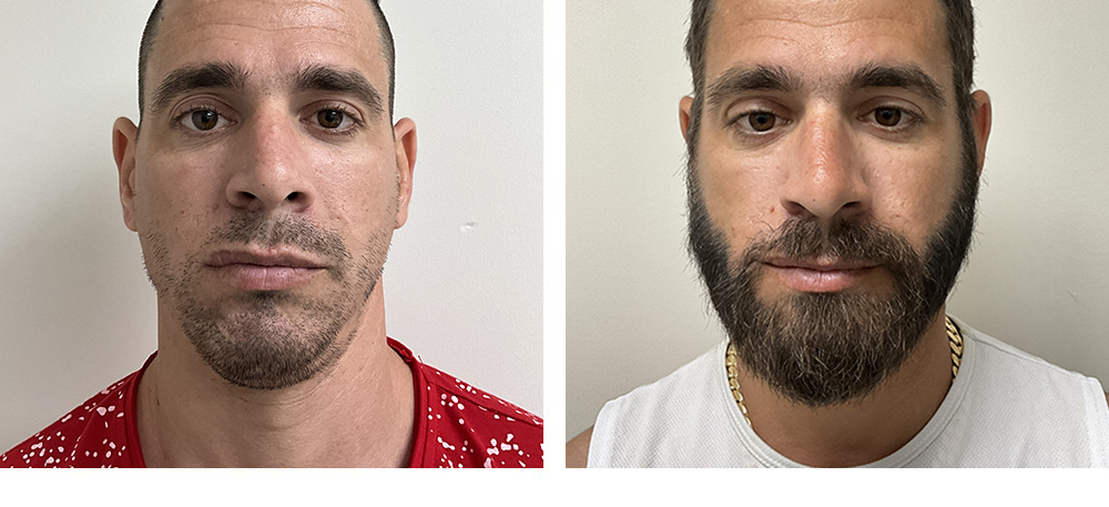 Beard Hair Transplant Before and After