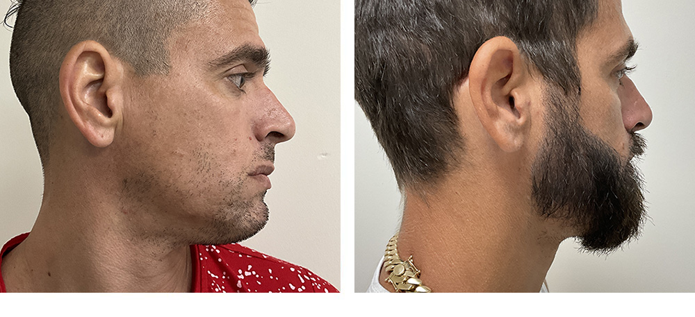 Beard Hair Transplant Before and After