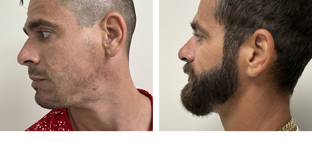 Beard Hair Transplant Before and After