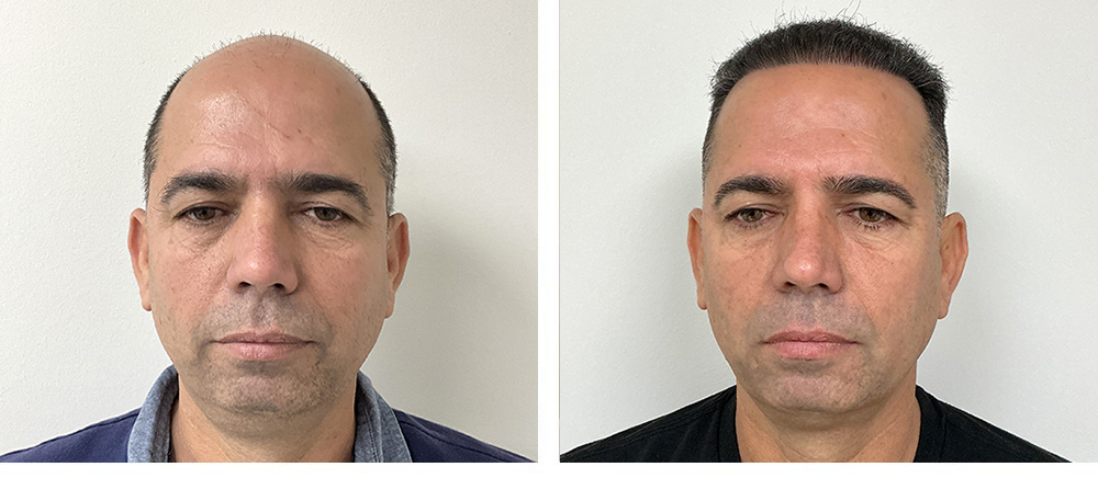 Hair Restoration Before and After