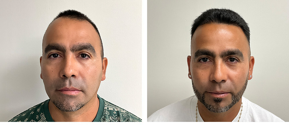 Hair Transplant Before and After