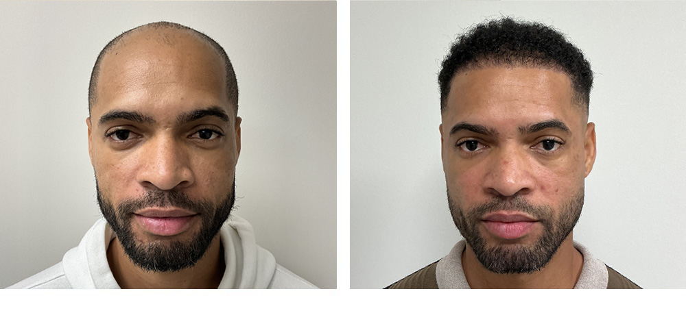 Hair Transplant Before and After