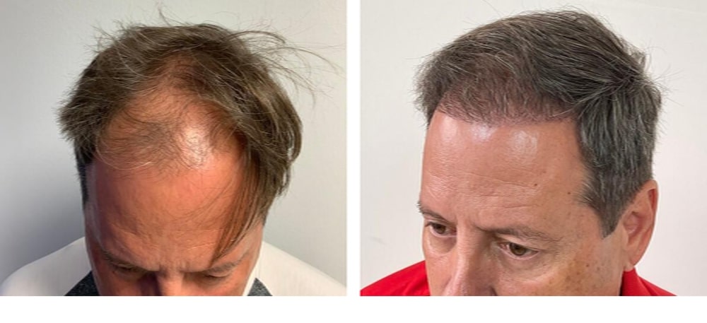 Hair Restoration Results Before and After