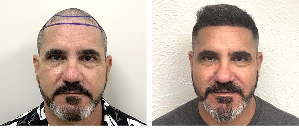 Hair Transplant Before and After