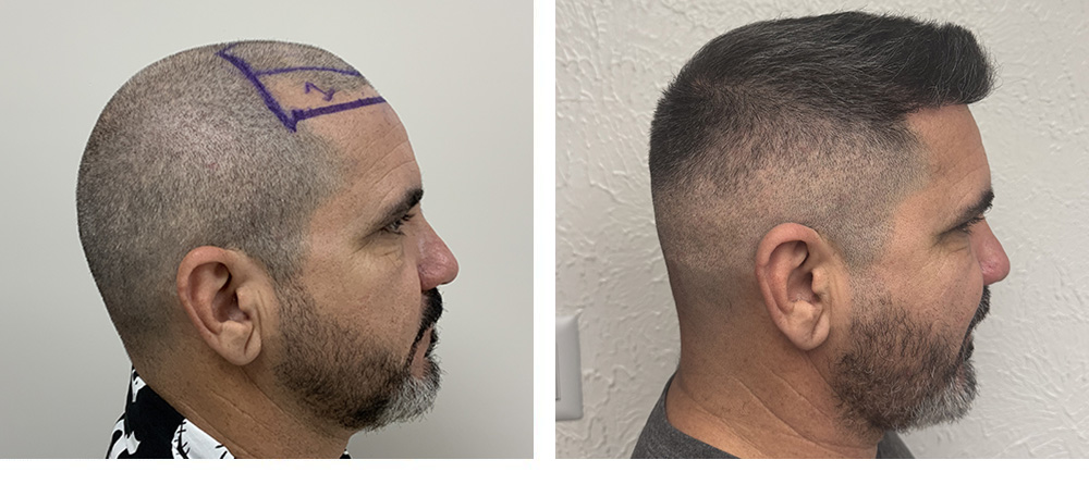 Hair Transplant Before and After