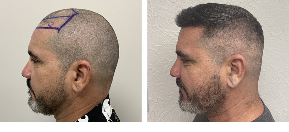 Hair Transplant Before and After