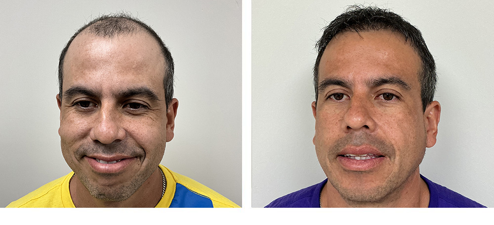 Hair Transplant Before and After