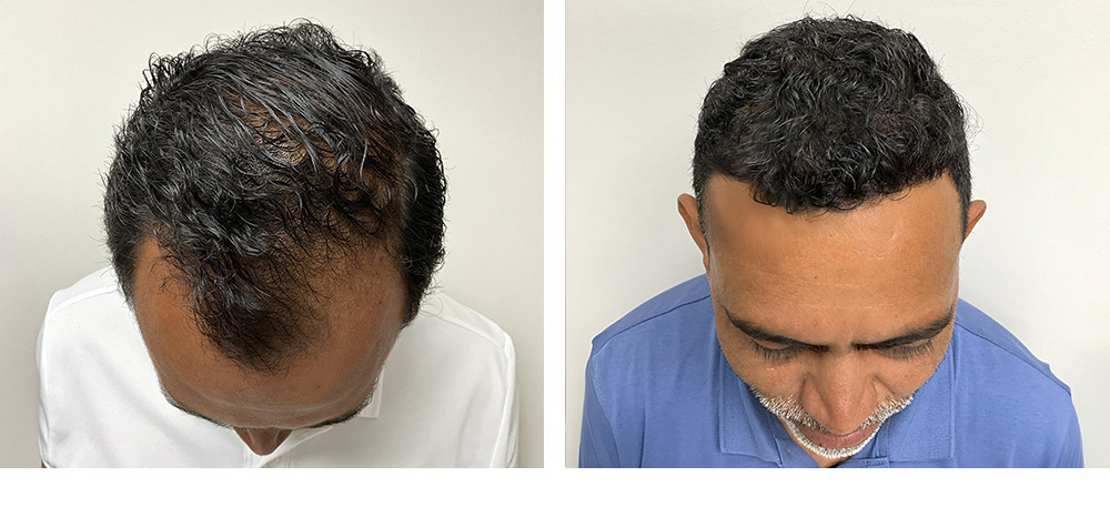 Hair Transplant Before and After