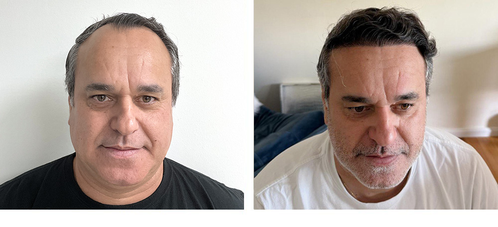 Hair Transplant Before and After