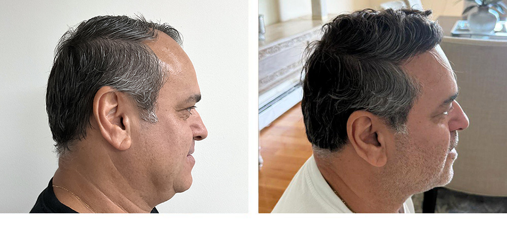 Hair Transplant Before and After