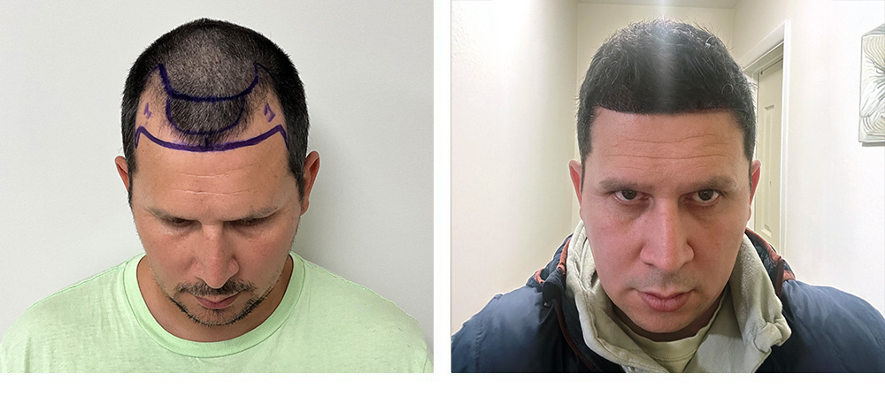 hair transplant before and after