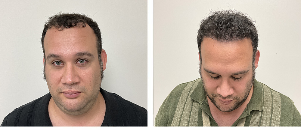 hair transplant before and after