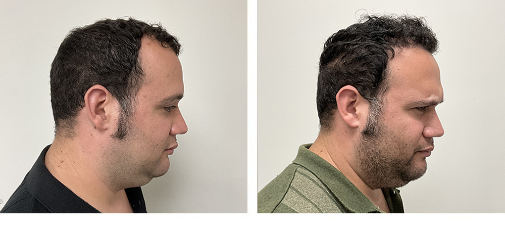 hair transplant before and after