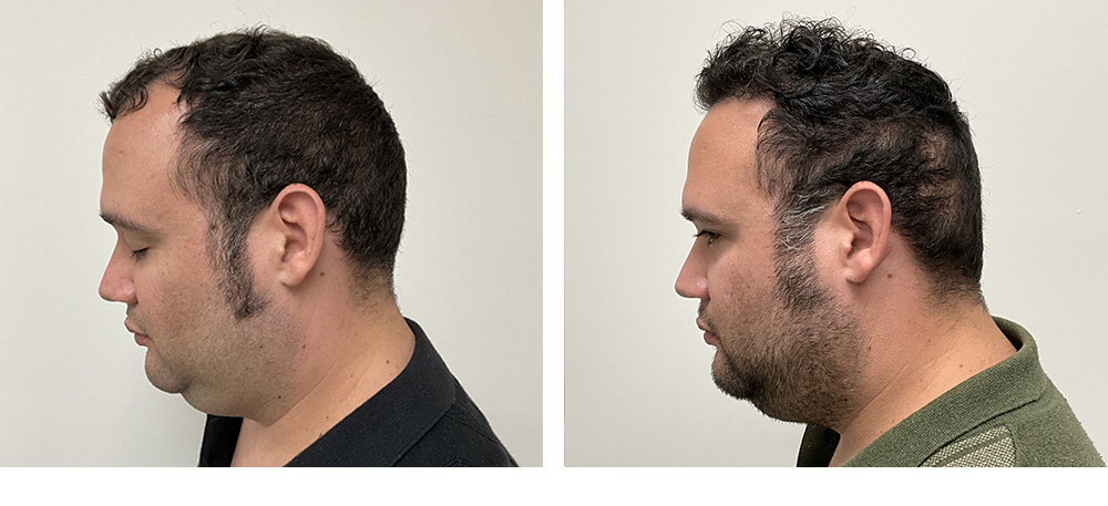 hair transplant before and after