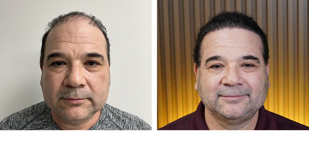 Hair Transplant Before and After