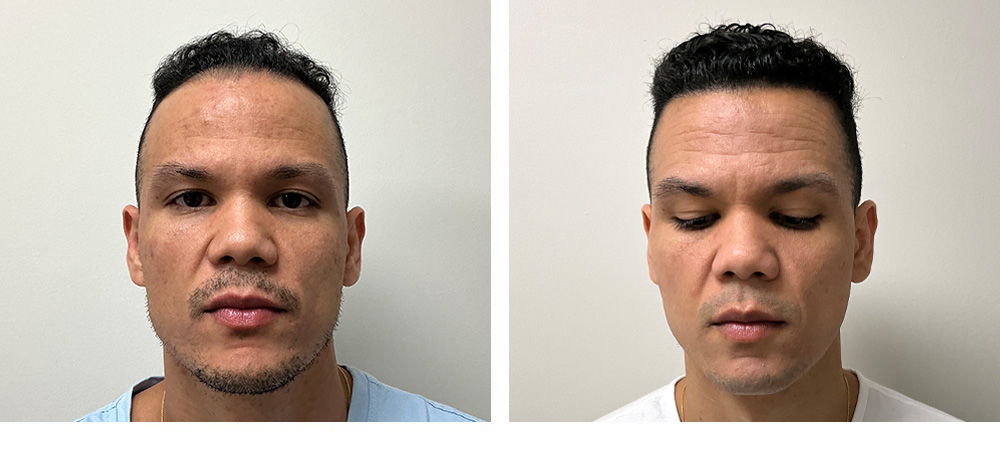 Hair Transplant Before and After