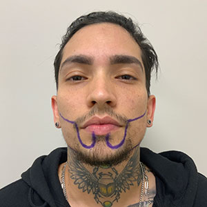 Fase de diseño del trasplante de Barba de Allan