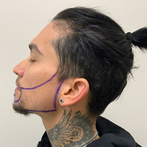 Fase de diseño del trasplante de Barba de Allan