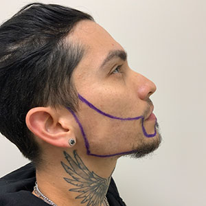 Fase de diseño del trasplante de Barba de Allan