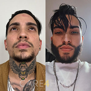Transplante de Barba Antes y Después
