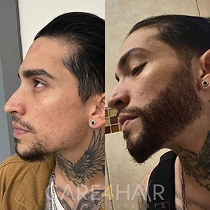 Transplante de Barba Antes y Después