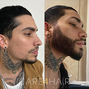 Transplante de Barba Antes y Después