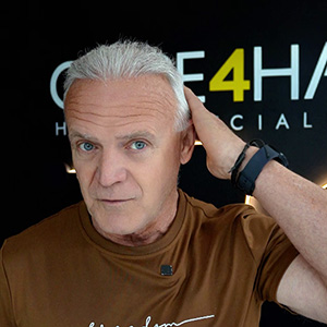 Carlos Calero restauración capilar tras 10 meses