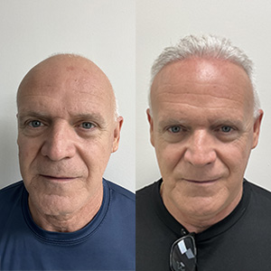 Carlos Calero y su restauración capilar Vista frontal