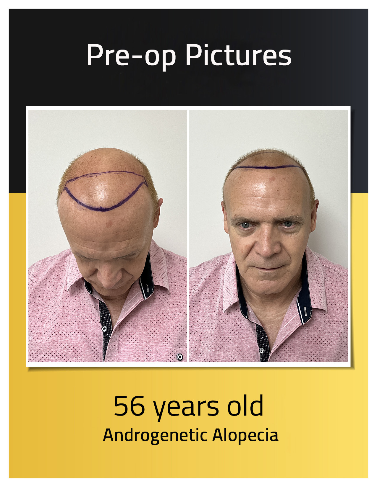 Carlos Calero transplant Pre-op photos