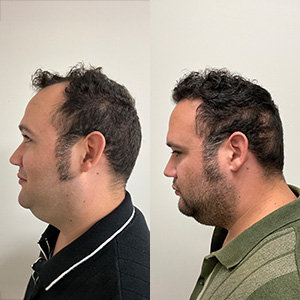 Eduardo Frómeta Vista izquierda antes y después del transplante capilar