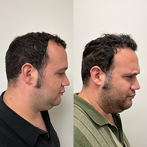 Eduardo Frómeta Vista derecha antes y después del transplante capilar