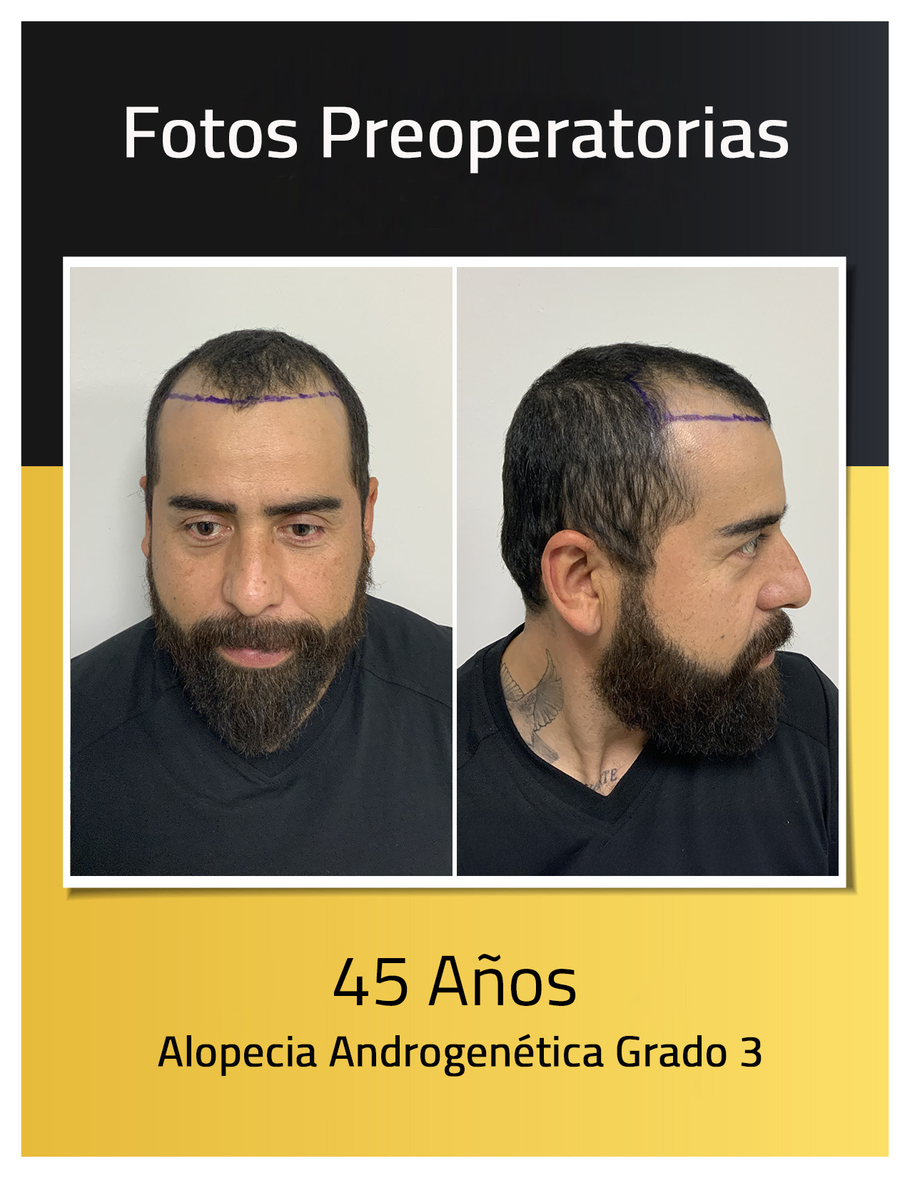 Fotos preoperatorias del trasplante de cabello de Angel Hidalgo