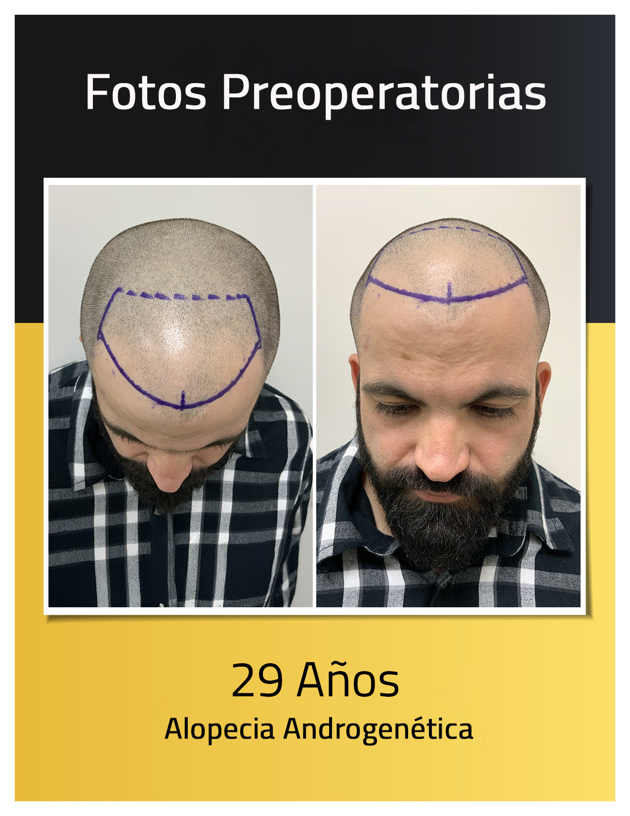 Fotos preoperatorias que muestran el grado de calvicie masculina de Iván