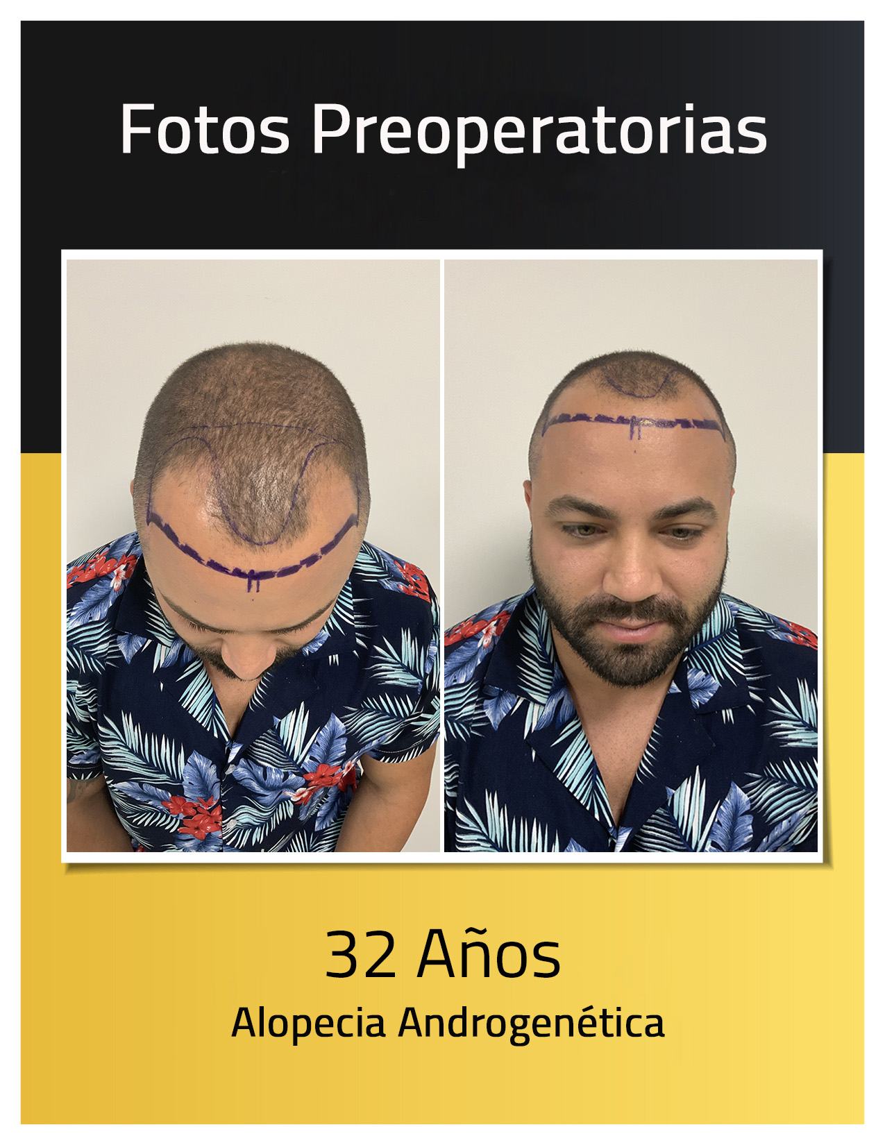 Fotos preoperatorias del trasplante capilar de Luis Sánchez