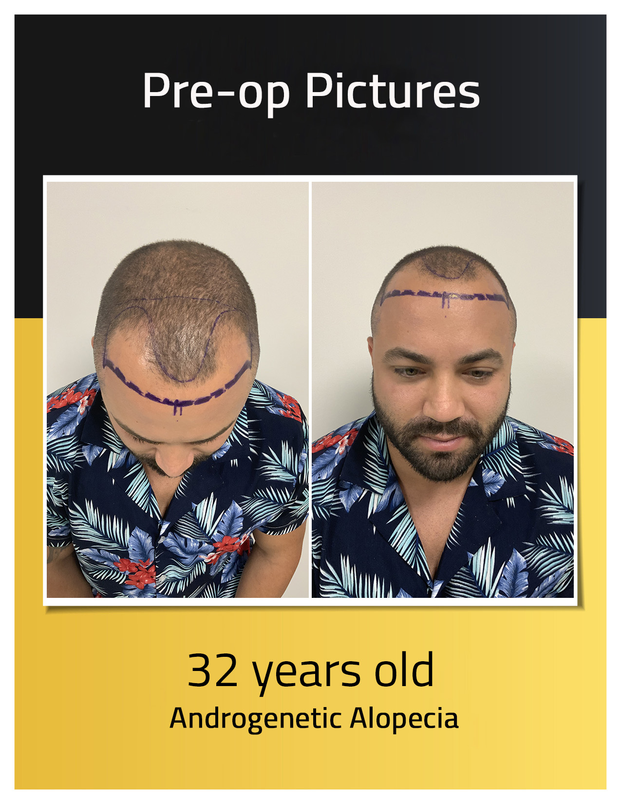 Pre-operative photos of Javier Cartagena's hair transplant