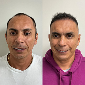 John Buitrago Restauración de Línea frontal antes y después