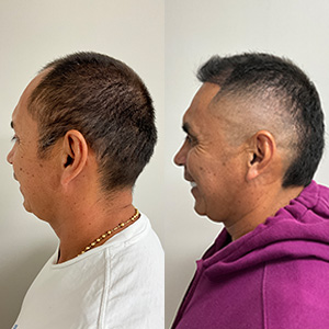 John Buitrago Restauración de Línea frontal antes y después