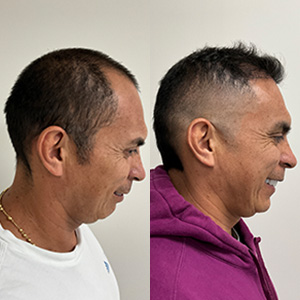 John Buitrago Restauración de Línea frontal antes y después