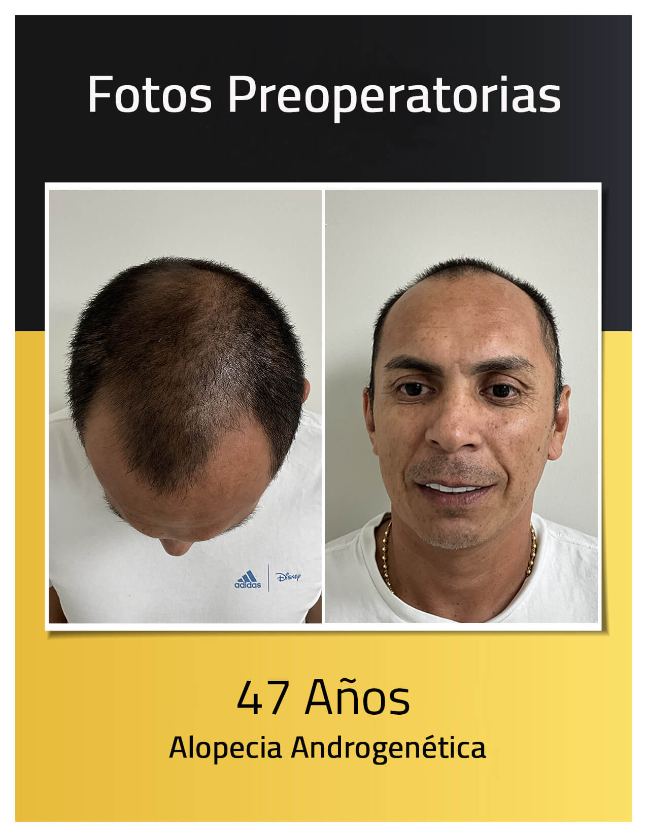 Fotos preoperatorias del trasplante capilar de John Buitrago