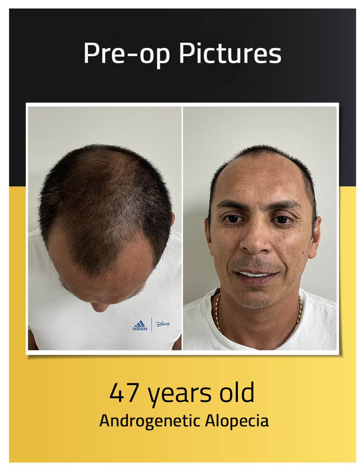 Pre-operative photos of Luis Sanchez's hair transplant