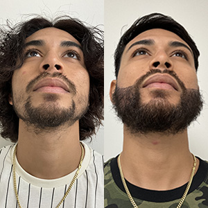 Reconstrucción de Barba Antes y Después