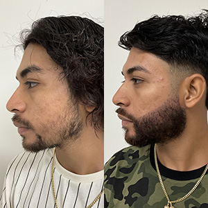 Reconstrucción de Barba Antes y Después