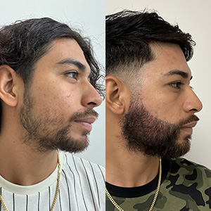 Reconstrucción de Barba Antes y Después