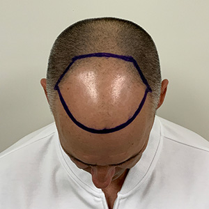 Día de la cirugía de trasplante de cabello de José Luis