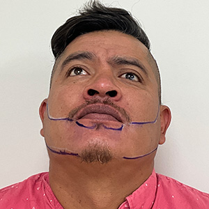 Fase de diseño del trasplante de Juan Carlos Beard