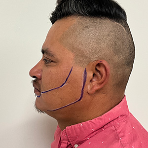 Fase de diseño del trasplante de Juan Carlos Beard