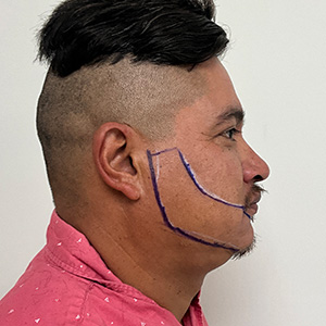 Fase de diseño del trasplante de Juan Carlos Beard